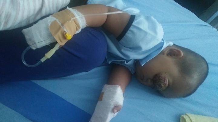Balita Mengidap Kanker Mata Kanan Perlu Operasi Angkat Kornea, Butuh Uluran Tangan para Dermawan